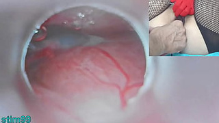 Asian Insemination with Sperm into Uterus and Endoscope Webcam by Cervix to watch inside womb Uncensored