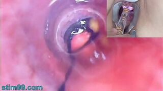 Old Woman Peehole Endoscope Web Camera in Bladder with Balls