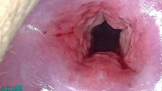 Uncensored Thai Cervix Stretching and Uterus Dilation with Penetration